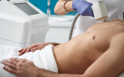 ÉPILATION DU DOS POUR LES HOMMES À LYON : COMMENT FONCTIONNE L’ÉPILATION LASER DU DOS